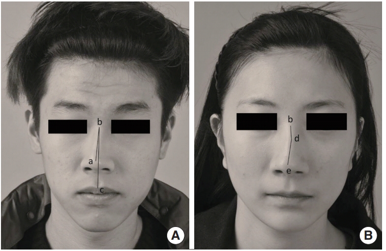 revision rhinoplasty expert los angeles revision rhinoplasty expert los angeles