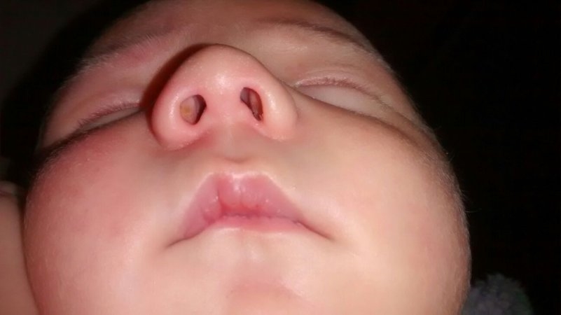 revision rhinoplasty expert los angeles revision rhinoplasty expert los angeles